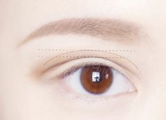 双眼皮失败修复手术的注意事项