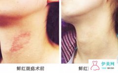 激光治疗鲜红斑痣的效果