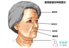 常见面部皱纹有哪些