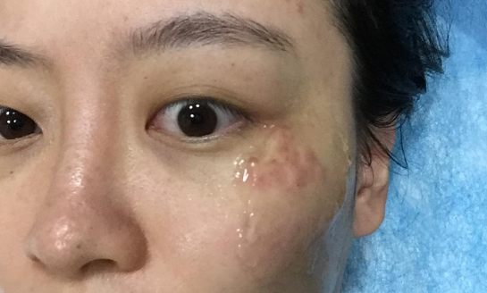 南京自体脂肪填充苹果肌整容医院哪家好？